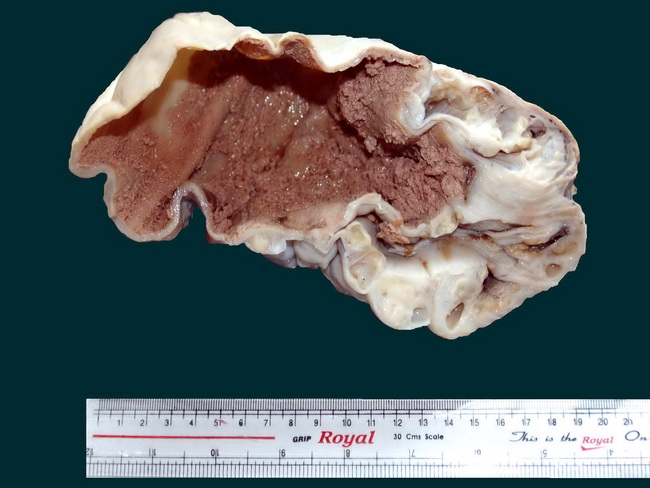 Sertoli-Leydig Cell Tumor 1.jpg